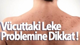 Vücuttaki Leke Problemine Dikkat !