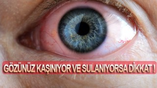 Gözünüz kaşınıyor ve sulanıyorsa dikkat !