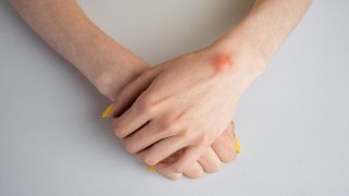 Ganglion kistine dikkat
